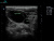 Alpinion E-cube inno Аппарат УЗИ Alpinion E-cube inno Аппарат УЗИ