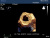 Philips iE33 Аппарат УЗИ Philips iE33 Аппарат УЗИ